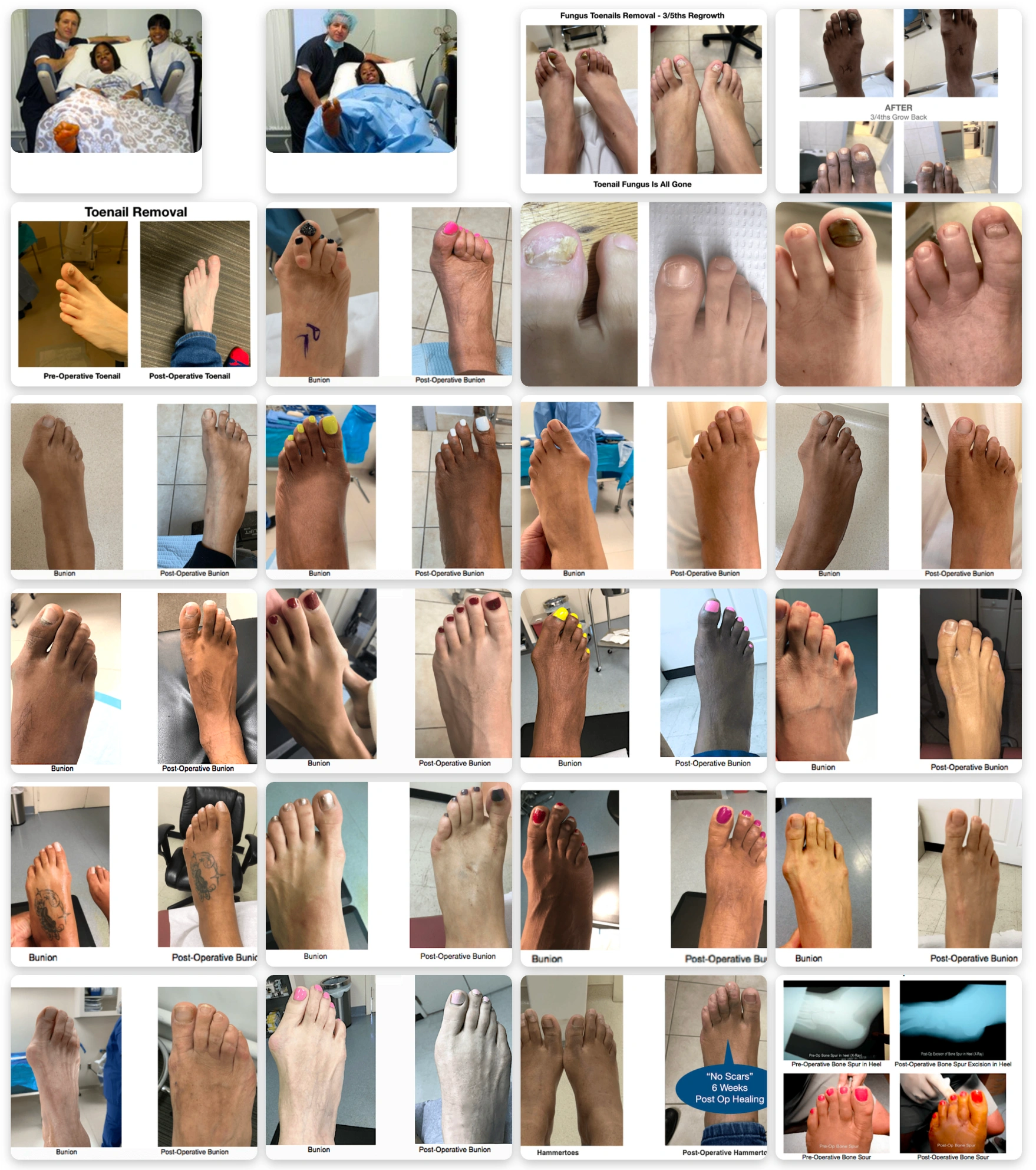 Before and After Collection: Foot Surgeries for Bunions, Hammertoes, and Toenail Removals Before & afters of foot surgeries: bunions, hammertoes, toenail removals, & post-op results